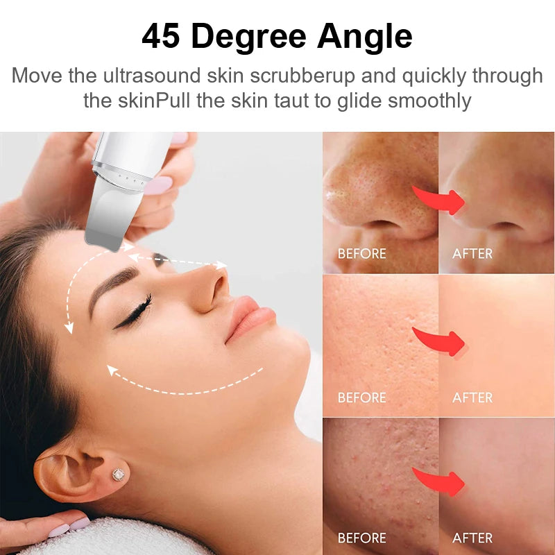 Ultrasonic Skin Scrubber for Deep Blackhead Removal DermaStorm
