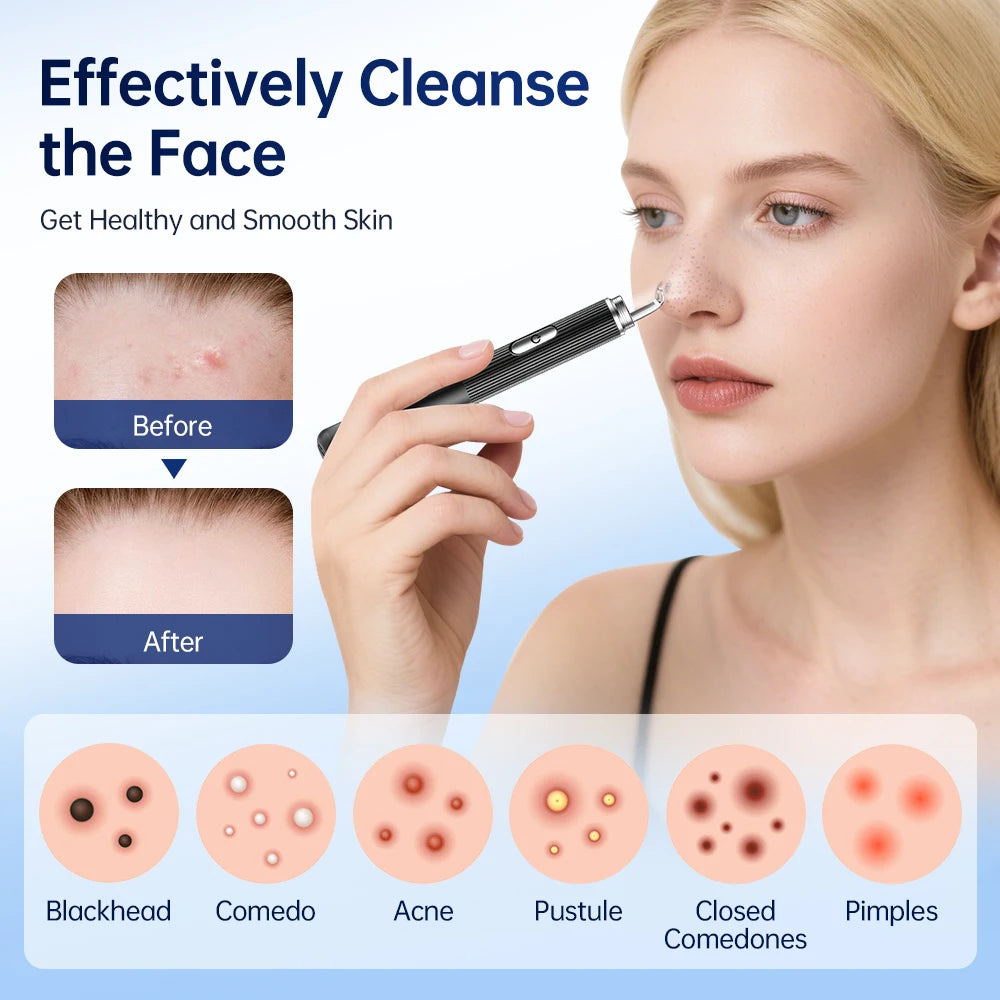 Visual Blackhead Remover with Camera Pimple Popper Extractor Tool Pore Cleaner Kit for Acne Comedone Whitehead Black Dots Remove  FitiqueFit