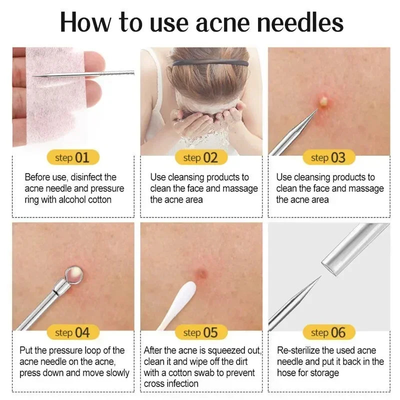 11‑Piece Ultra‑Fine Acne & Blackhead Tweezers Set DermaStorm