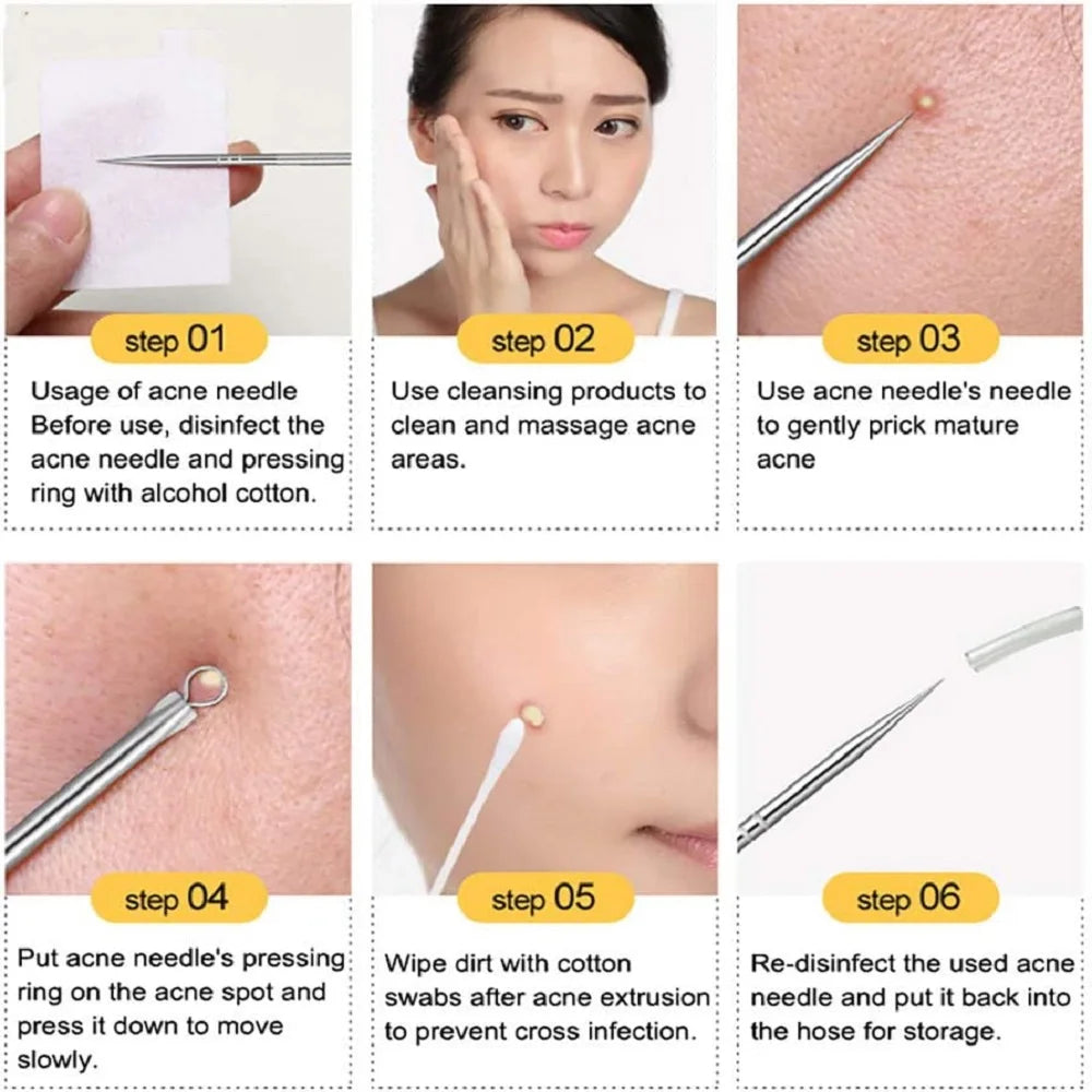 Dighealth 4PCS Stainless Steel Blackhead Remover Extraction Pimple Comedone Acne Extractor Whitehead Blemish Popper Kit  FitiqueFit