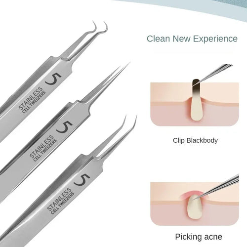 11‑Piece Ultra‑Fine Acne & Blackhead Tweezers Set DermaStorm